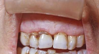 Кариес зубов: симптомы, стадии протекания заболевания и фото С чего начинается кариес зубов